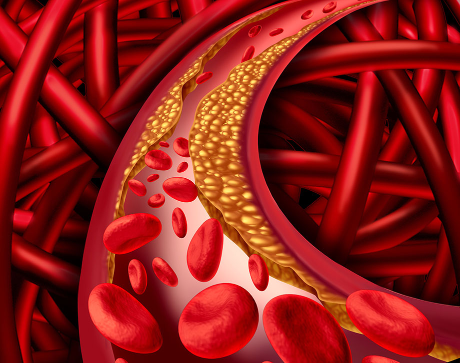 About high cholesterol | My Health My Life