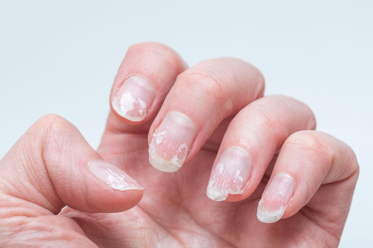 Brittle or Splitting Nails? Your Body May Be Warning You About Nutrient Deficiency Chapter 1